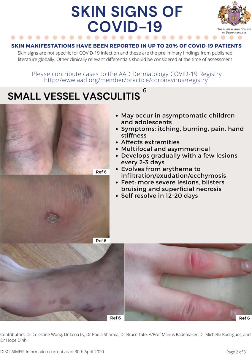 DermatologyACD's tweet photo. Skin Signs of COVID-19” - Fellows of the ACD have gone through the recent literature and have put together summary of skin findings associated with COVID-19. https://t.co/vlKCjTqMXj