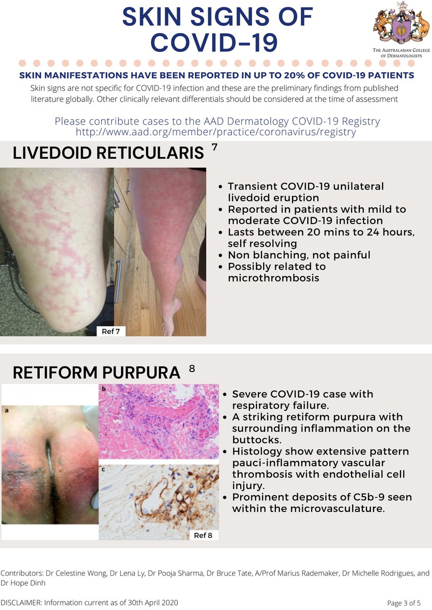 DermatologyACD's tweet photo. Skin Signs of COVID-19” - Fellows of the ACD have gone through the recent literature and have put together summary of skin findings associated with COVID-19. https://t.co/vlKCjTqMXj