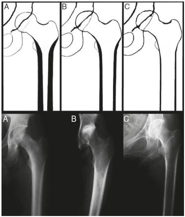 Orthopaedics MSc UCL (@orthomscucl) on Twitter photo Dorr classification attempts to guide indications for cemented or uncemented femoral component fixation.
Suggested femoral component fixation for:
1) type A & B -> uncemented
2) type C -> cemented 
#orthotwitter #MScUCL Dorr classification attempts to guide indications for cemented or uncemented femoral component fixation.
Suggested femoral component fixation for:
1) type A & B -> uncemented
2) type C -> cemented 
#orthotwitter #MScUCL