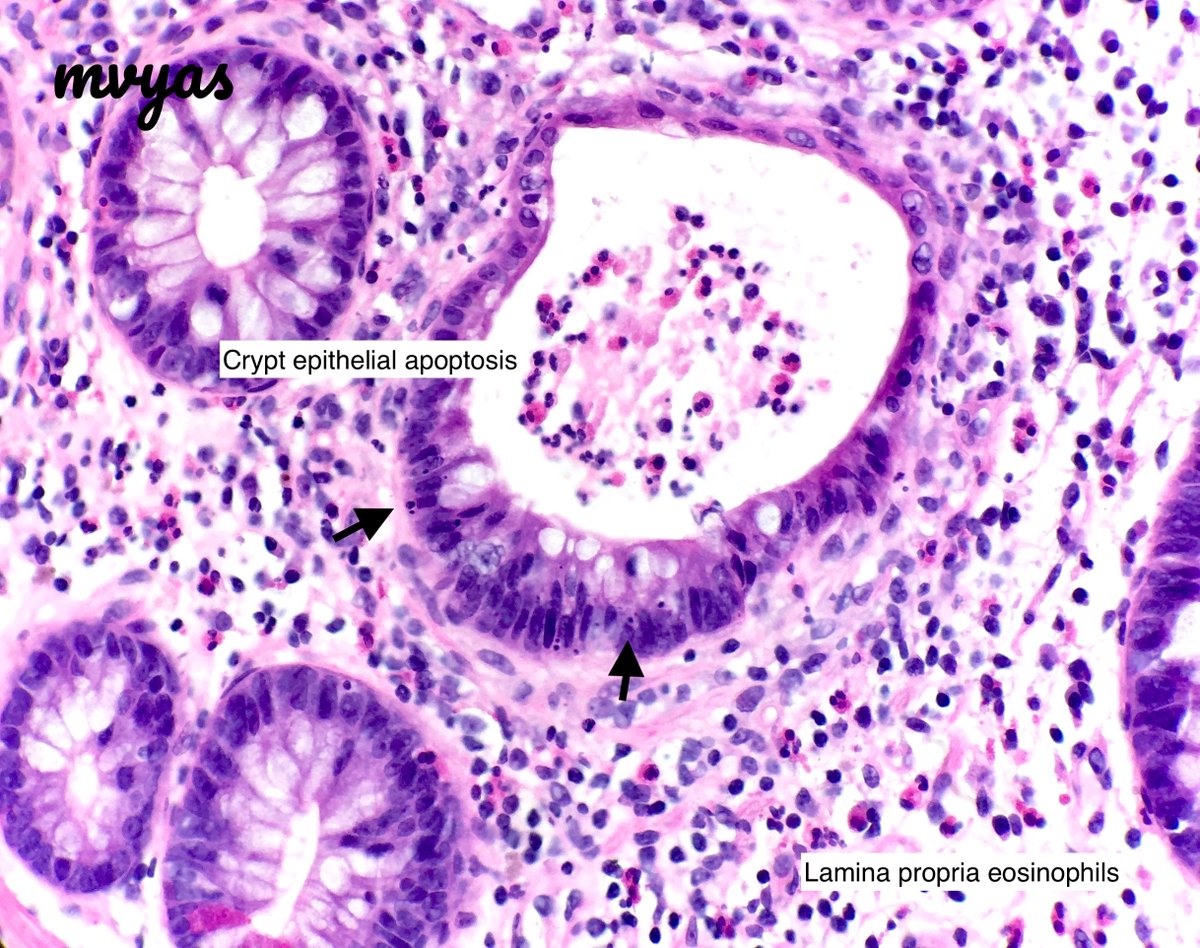 Mycophenolate mofetil (MMF/Cellcept) associated colitis is a mimicker of GVHD:
Clinical - solid organ/stem cell transplant (SCT)
Classic features:
- Damaged dilated crypts/drop out
- Prominent crypt apoptosis
- Increased eosinophils in LP
#GIpath #pathtweetorial