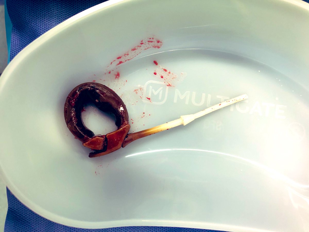 DrKevinJChan's tweet photo. Lap band erosion is a known complication of gastric banding. 

Symptoms can include vomiting, upper abdo pain, port site infections, loss of restriction and weight regain. 

#ugi #bariatricsurgery #lapband #lapbanderosion https://t.co/oISgHpmnc0