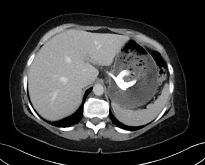DrKevinJChan's tweet photo. Lap band erosion is a known complication of gastric banding. 

Symptoms can include vomiting, upper abdo pain, port site infections, loss of restriction and weight regain. 

#ugi #bariatricsurgery #lapband #lapbanderosion https://t.co/oISgHpmnc0