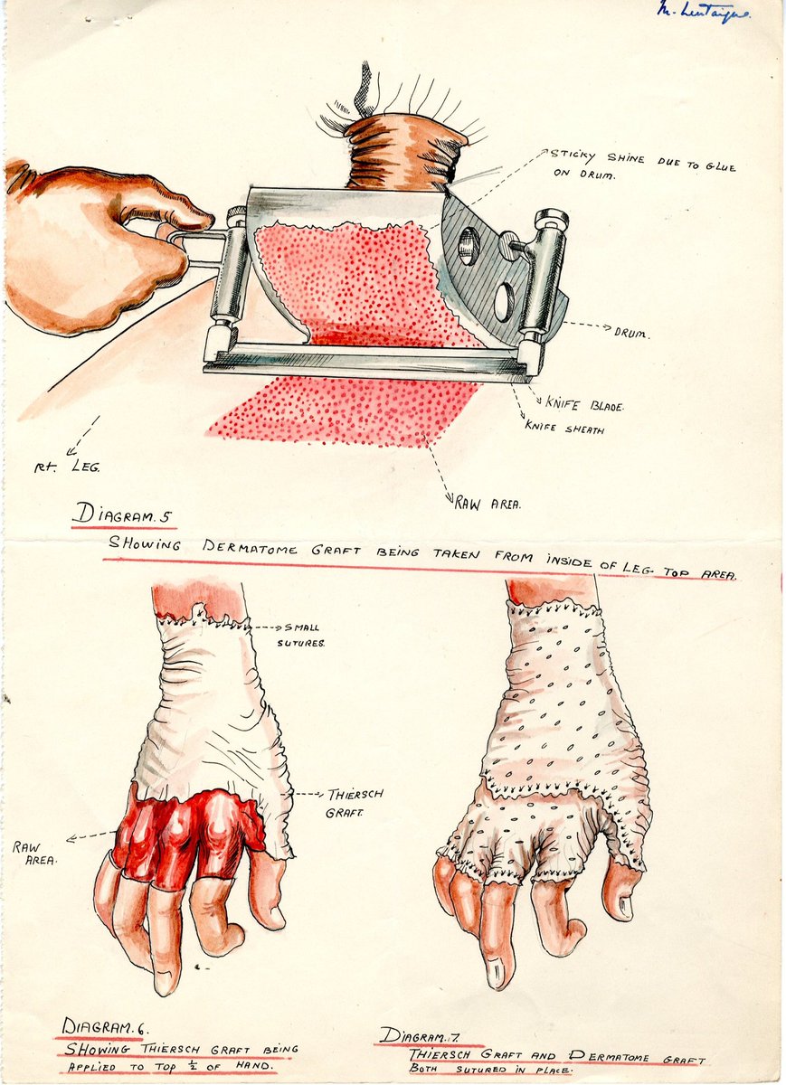 alex_j_baldwin's tweet image. Happy 100th Birthday to Mollie Lentaigne! 🎂

This amazing woman was a nurse and medical artist at @QVH during WW2. She drew hundreds of #PlasticSurgery operations carried out by Archibald McIndoe on the famous Guinea Pig Club. (1/ 7)