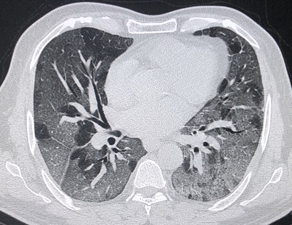 DrChinkyChatur's tweet image. No points for guessing the diagnosis!!
Every image speaks a thousand words!
#DailyReporting #ImagesinRadiology #stressfultimes #StaySafeStayHealthy