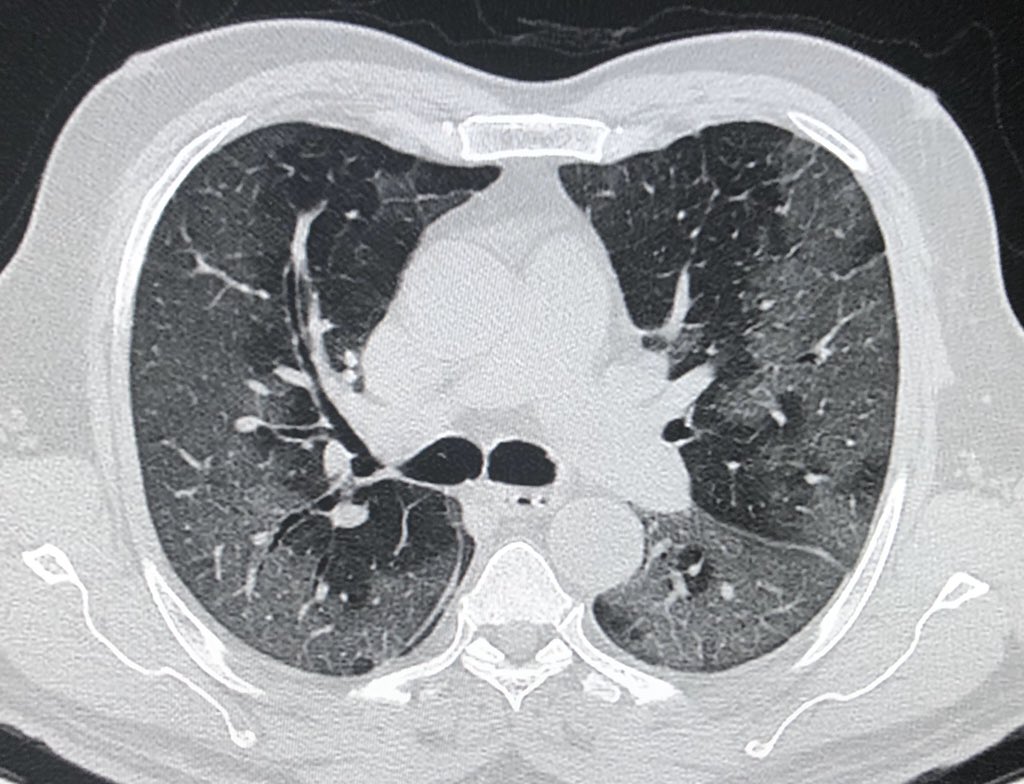 DrChinkyChatur's tweet image. No points for guessing the diagnosis!!
Every image speaks a thousand words!
#DailyReporting #ImagesinRadiology #stressfultimes #StaySafeStayHealthy