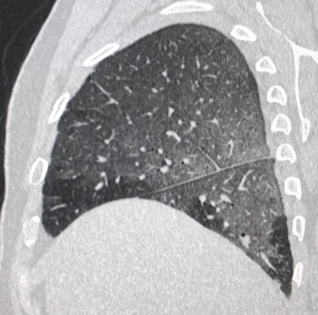 DrChinkyChatur's tweet image. No points for guessing the diagnosis!!
Every image speaks a thousand words!
#DailyReporting #ImagesinRadiology #stressfultimes #StaySafeStayHealthy
