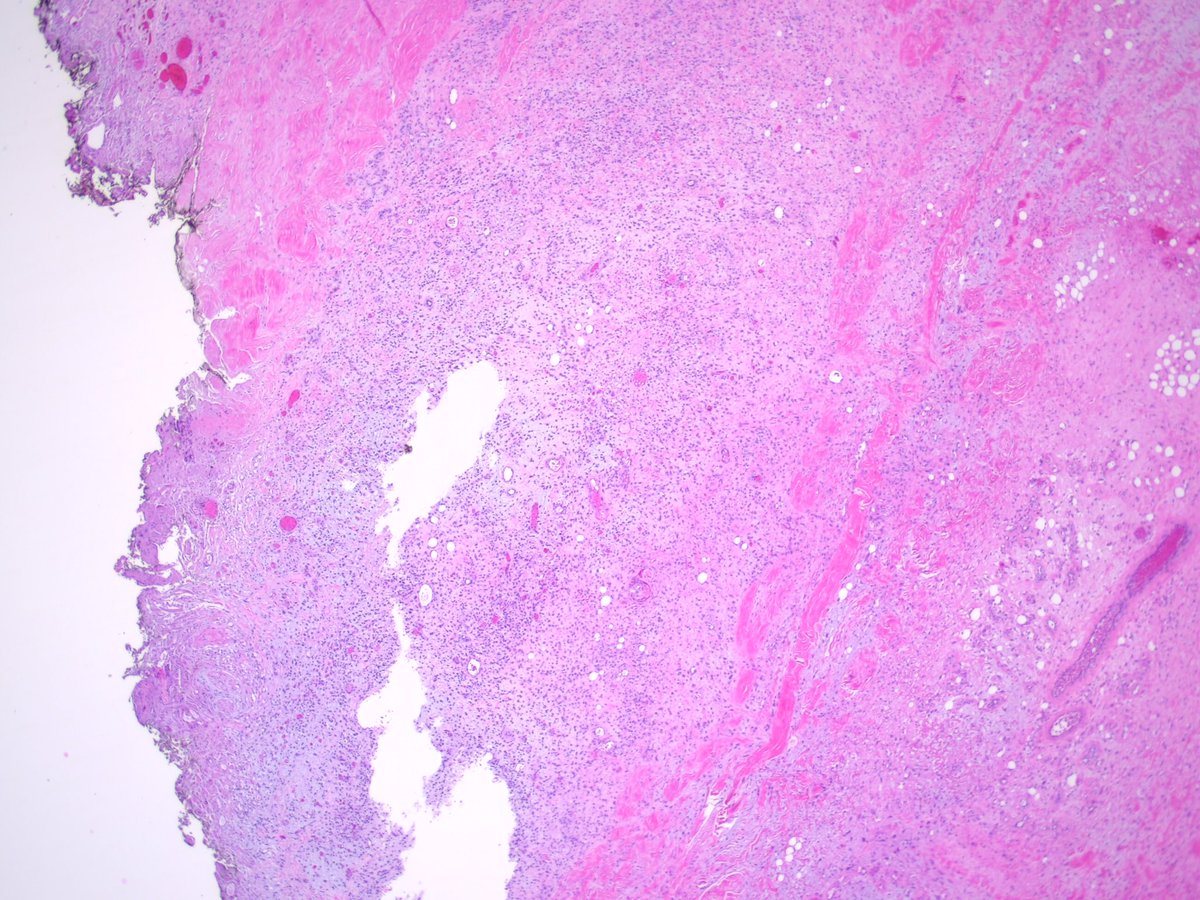 Teclis82's tweet photo. #BSTpath: 75 year old man, lower back lesion, resected.
#Pathresidents: Ddx? If malignant, workup? If benign, got a name for it?
Maybe after some have weighed in we can ask @JMGardnerMD if we (including me...) are right or not!
1/3 https://t.co/ahiegcbiz4