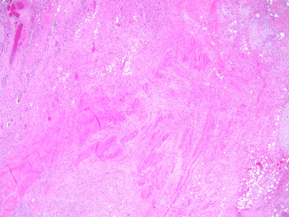 Teclis82's tweet photo. #BSTpath: 75 year old man, lower back lesion, resected.
#Pathresidents: Ddx? If malignant, workup? If benign, got a name for it?
Maybe after some have weighed in we can ask @JMGardnerMD if we (including me...) are right or not!
1/3 https://t.co/ahiegcbiz4