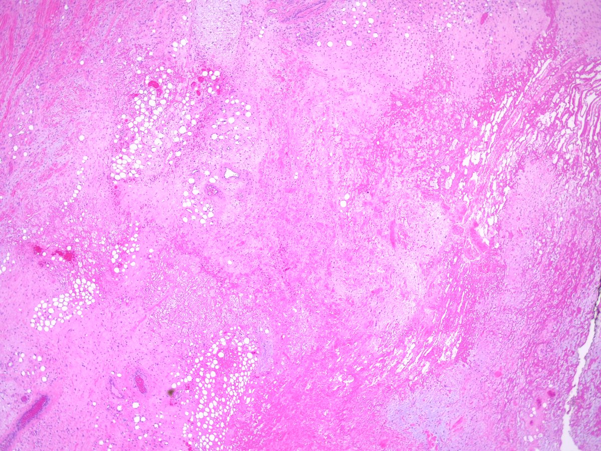 Teclis82's tweet photo. #BSTpath: 75 year old man, lower back lesion, resected.
#Pathresidents: Ddx? If malignant, workup? If benign, got a name for it?
Maybe after some have weighed in we can ask @JMGardnerMD if we (including me...) are right or not!
1/3 https://t.co/ahiegcbiz4