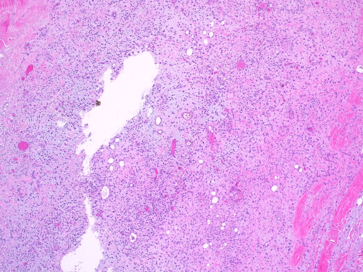 Teclis82's tweet photo. #BSTpath: 75 year old man, lower back lesion, resected.
#Pathresidents: Ddx? If malignant, workup? If benign, got a name for it?
Maybe after some have weighed in we can ask @JMGardnerMD if we (including me...) are right or not!
1/3 https://t.co/ahiegcbiz4