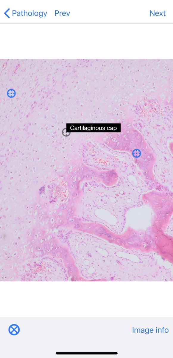 BoSTT_app's tweet photo. Case 99. A rare subungual lesion to compare to case 98. Stay safe and enjoy. #radiology #pathology #MSKrad #BSTPath  #FOAMed #FOAMed https://t.co/7ucIs0Mdc6