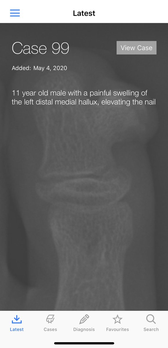BoSTT_app's tweet photo. Case 99. A rare subungual lesion to compare to case 98. Stay safe and enjoy. #radiology #pathology #MSKrad #BSTPath  #FOAMed #FOAMed https://t.co/7ucIs0Mdc6