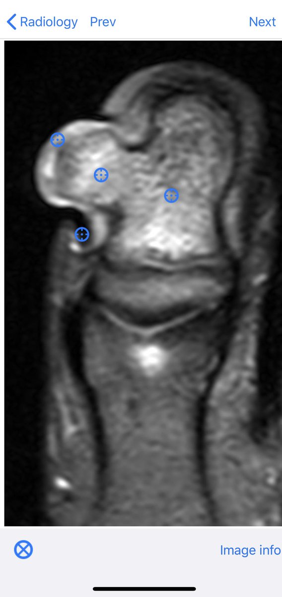 BoSTT_app's tweet photo. Case 99. A rare subungual lesion to compare to case 98. Stay safe and enjoy. #radiology #pathology #MSKrad #BSTPath  #FOAMed #FOAMed https://t.co/7ucIs0Mdc6