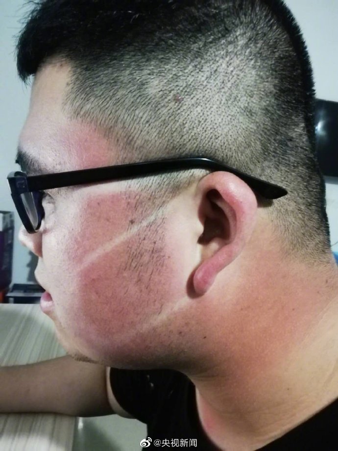 Cgtn Respect Goes To An Auxiliary Police Officer In Northwest China S Shaanxi Province Who Found His Face Marked With Tan Lines From Wearing A Mask While Being On Duty Under Cgtn Respect Goes To An Auxiliary Police Officer In Northwest China S Shaanxi Province Who Found His Face Marked With Tan Lines From Wearing A Mask While Being On Duty Under
