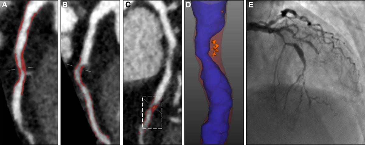 CircAHA's tweet image. Low-Attenuation Noncalcified Plaque on Coronary Computed Tomography Angiography Predicts #MI: Results From the Multicenter SCOT-HEART Trial. Learn more: ow.ly/kFHe50zxrbG #AHAJournals @imagingmedsci @EdinUniImaging @EdinburghUni