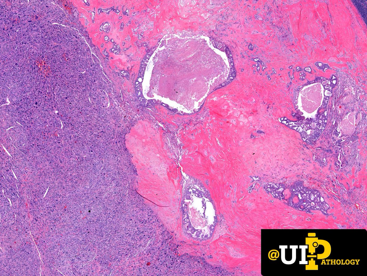 UIPathology's tweet photo. It's time for another #IowaPath Wednesday! This week's case is from a parotid mass in an elderly patient. 

🔬What is your diagnosis?

#ENTpath https://t.co/bCYJuPuigc