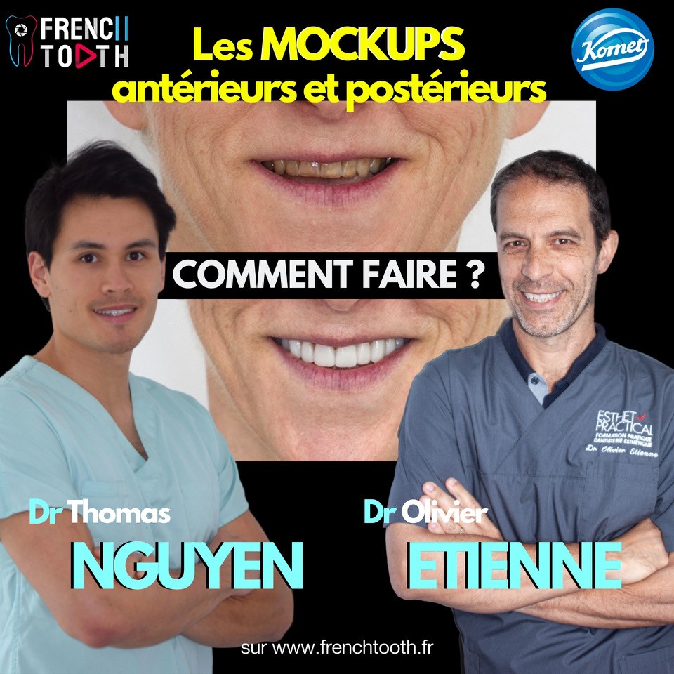 [WEBINAIRE] Komet et son nouveau partenaire French Tooth vous proposent un live vendredi à 15h sur frenchtooth.fr : les Drs Olivier Etienne et Thomas Nguyen nous montreront comment réaliser des mockups antérieurs et postérieurs