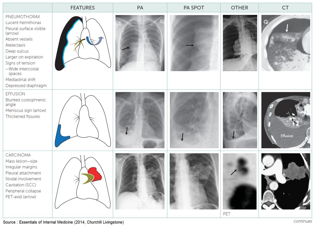 ManualOMedicine's tweet photo. Radiographic Features of Pulmonary Diseases . #meded #foamed #foamrad #medtwitter https://t.co/Db0flrePJv