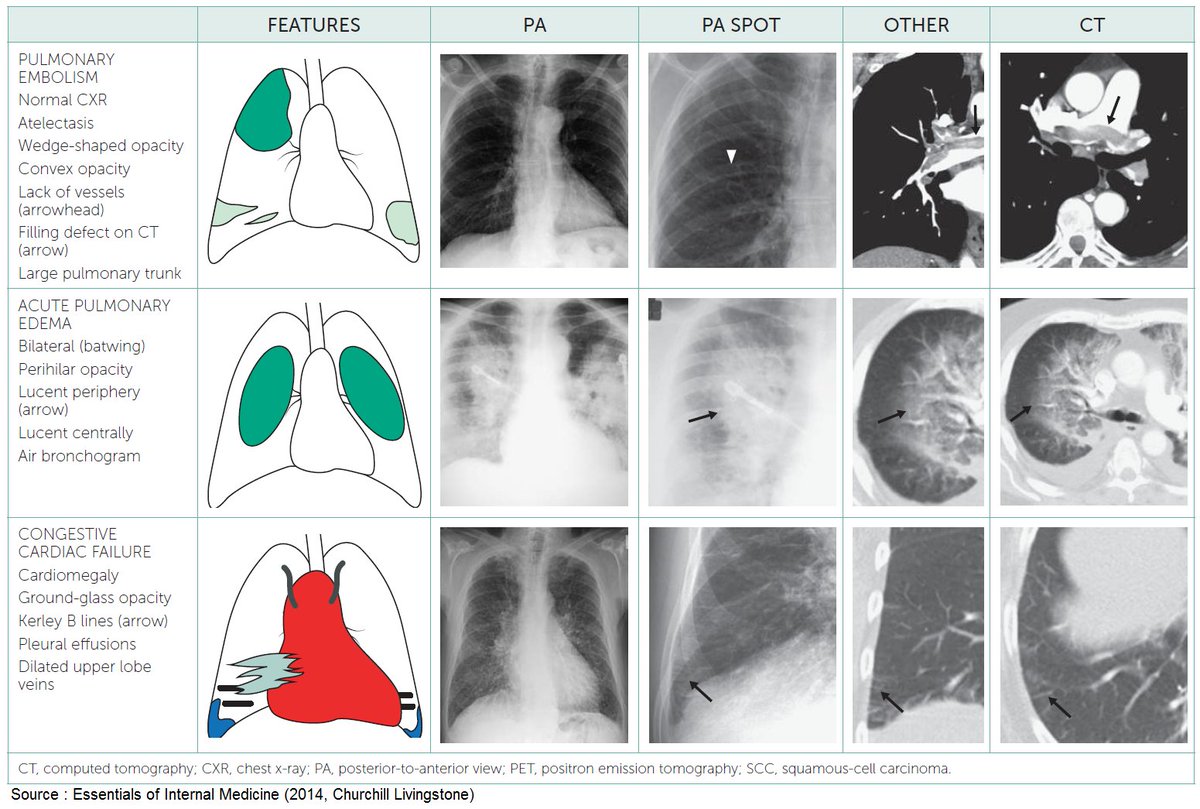 ManualOMedicine's tweet photo. Radiographic Features of Pulmonary Diseases . #meded #foamed #foamrad #medtwitter https://t.co/Db0flrePJv