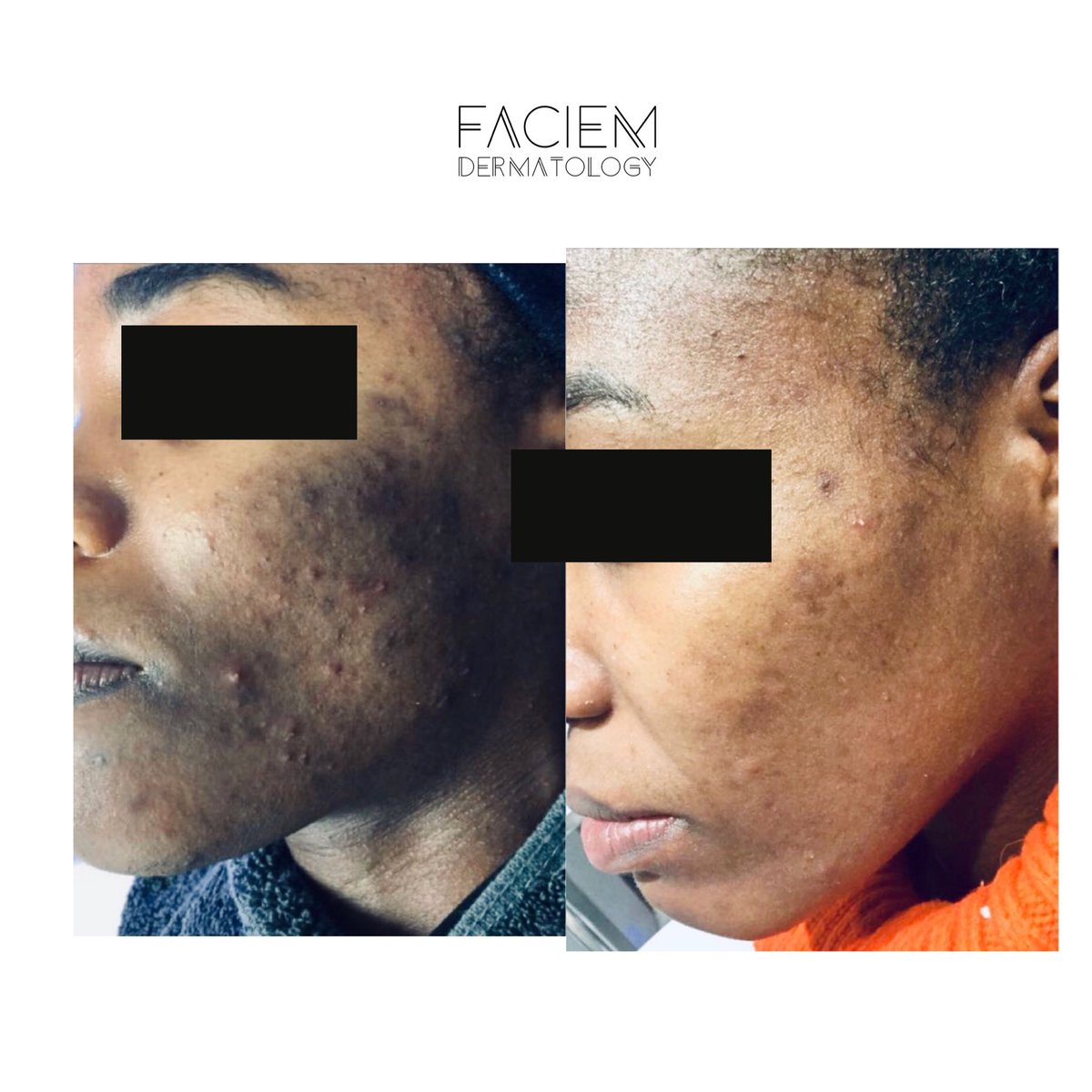 FaciemDerma's tweet photo. Skin is what we do and skin is what we know #acne treatment #hydrafacial , this lady has spent thousands before coming to use and within a few months we achieved these results through careful treatment and guidance https://t.co/i7cl0jW2G9