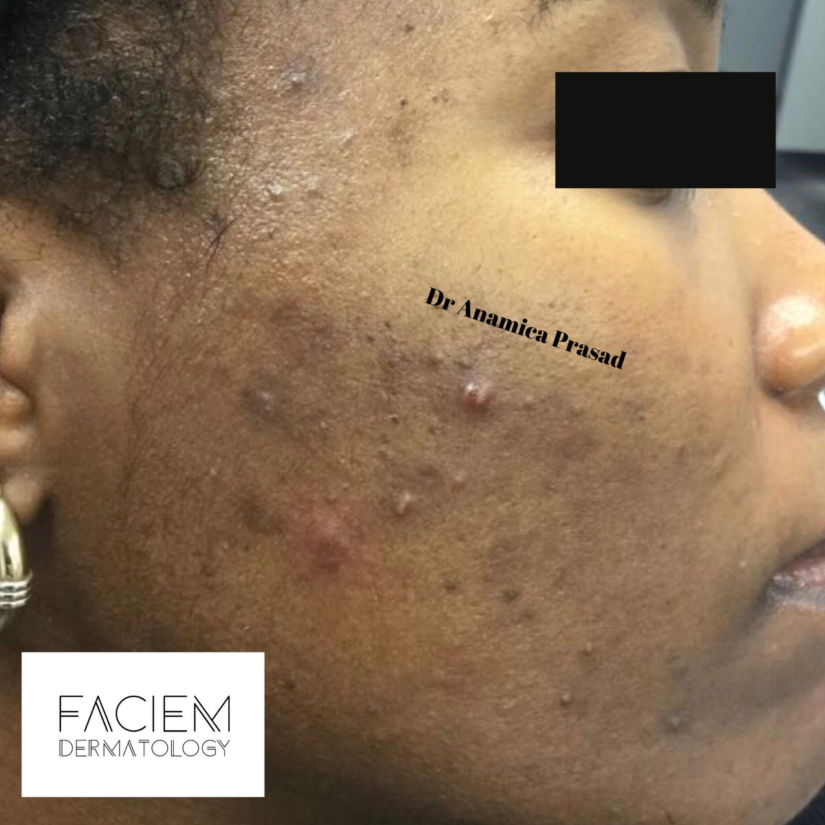 FaciemDerma's tweet photo. Skin is what we do and skin is what we know #acne treatment #hydrafacial , this lady has spent thousands before coming to use and within a few months we achieved these results through careful treatment and guidance https://t.co/i7cl0jW2G9