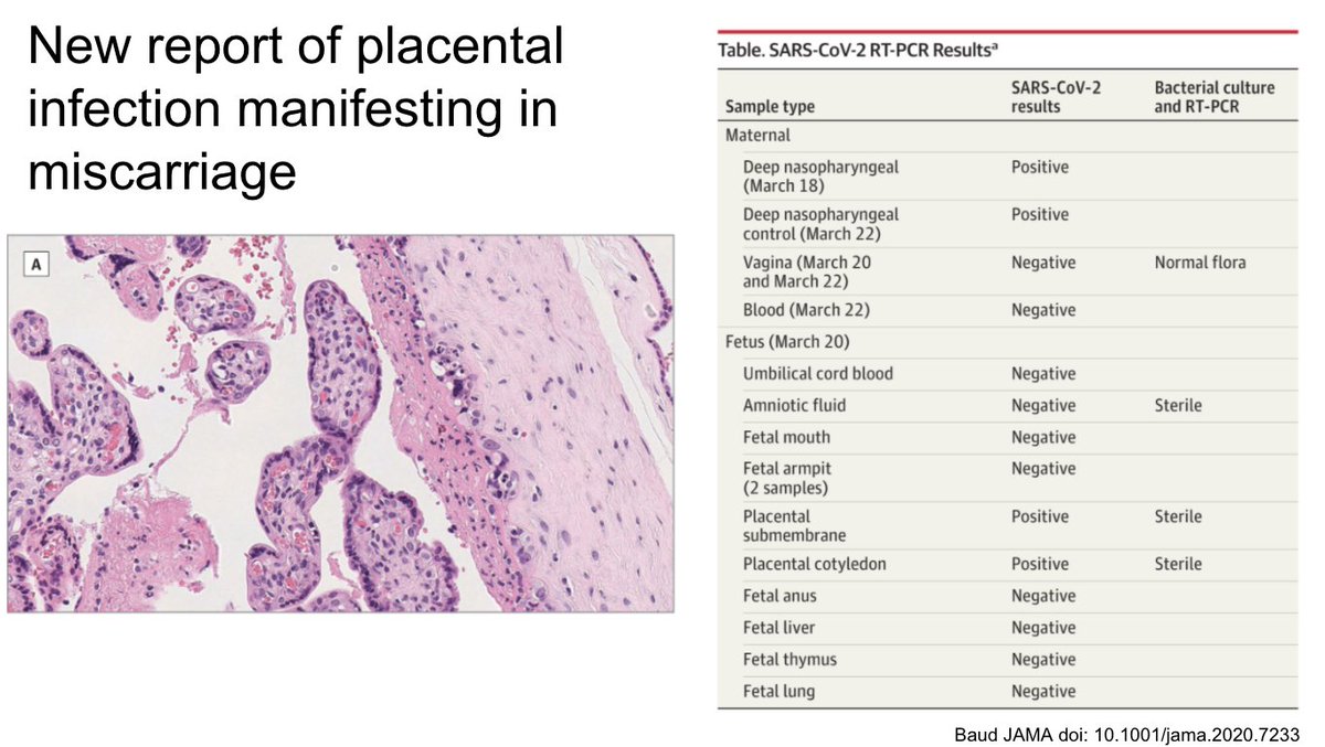 This recent report shows placental infection with SARS-CoV-2 leading to miscarriage