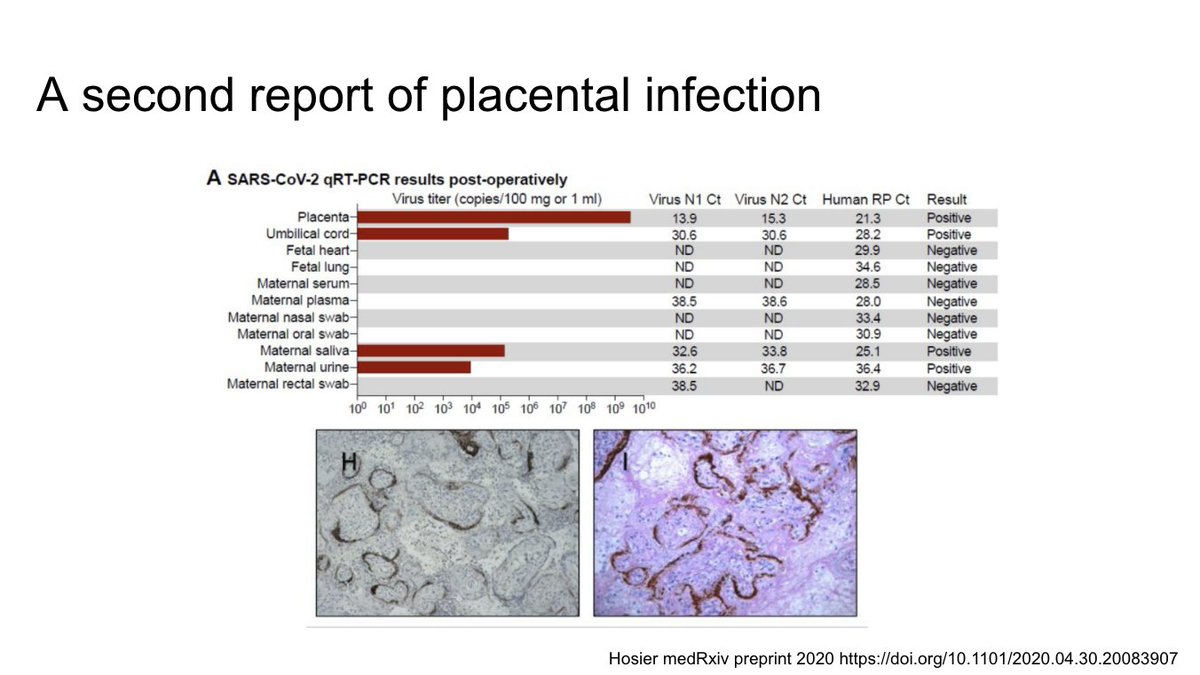 This is a second similar case. You can see the immunohistochemical staining for SARS-CoV-2 in the placenta