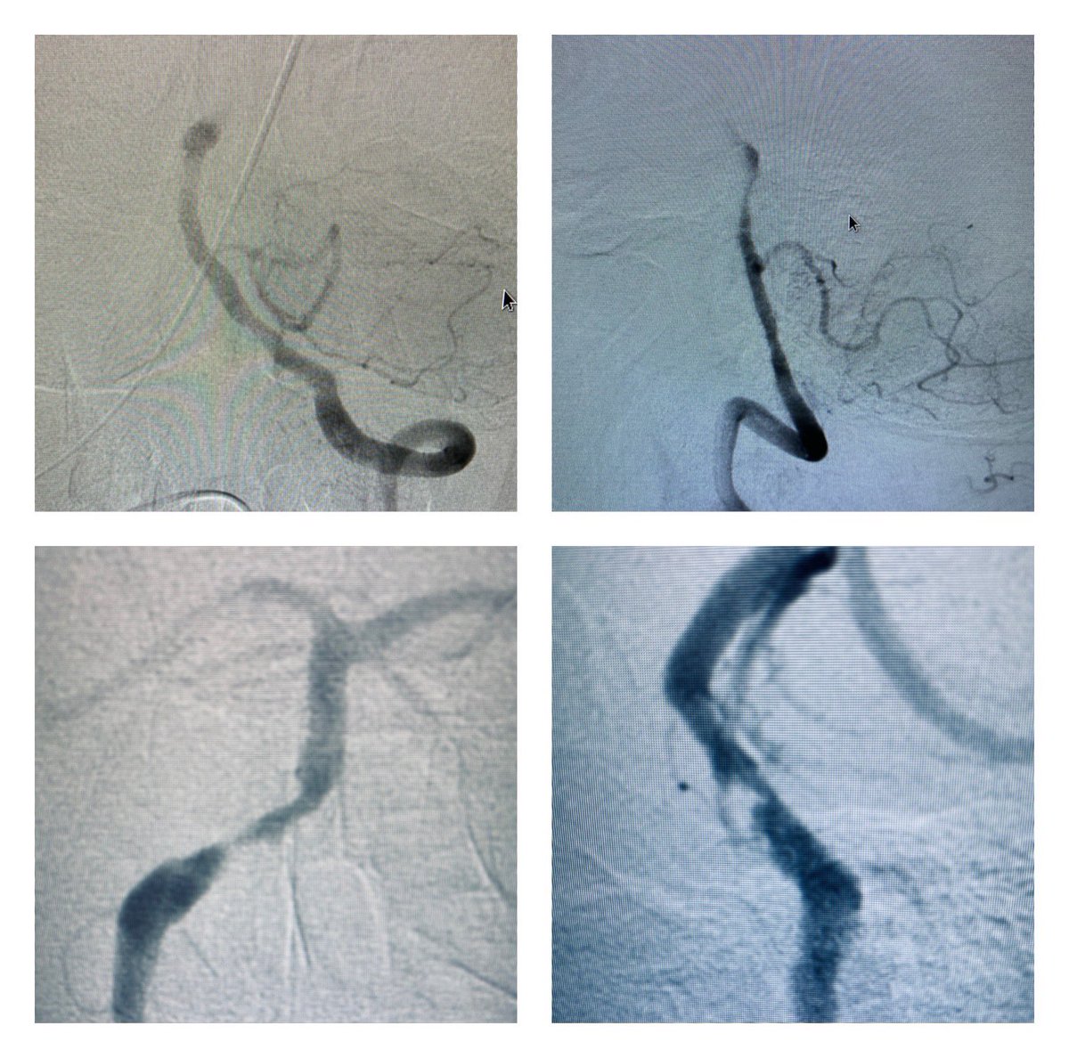 wondeasa's tweet photo. Good outcomes of the commonly deadly #basilar artery #Stroke are always more exciting, esp those requiring acute submax angioplasty/ stenting. Minimally responsive patient on arrival now awake with improving right side weakness. #ELVO #Stroke-awareness #Strokemonth #BrainForLife https://t.co/CEAbD2Gddp