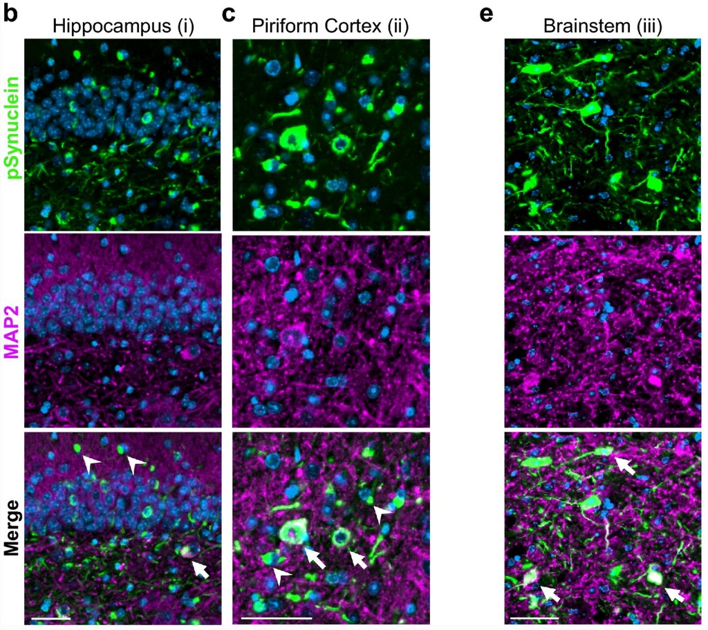 Multiple system atrophy prions retain strain specificity after serial propagation in two different Tg( SNCA *A53T) mouse lines. Confirmed transmission of α-synuclein prions to a second synucleinopathy model. bit.ly/2VRedTZ @SalvoSpinaSF @grinberg_t