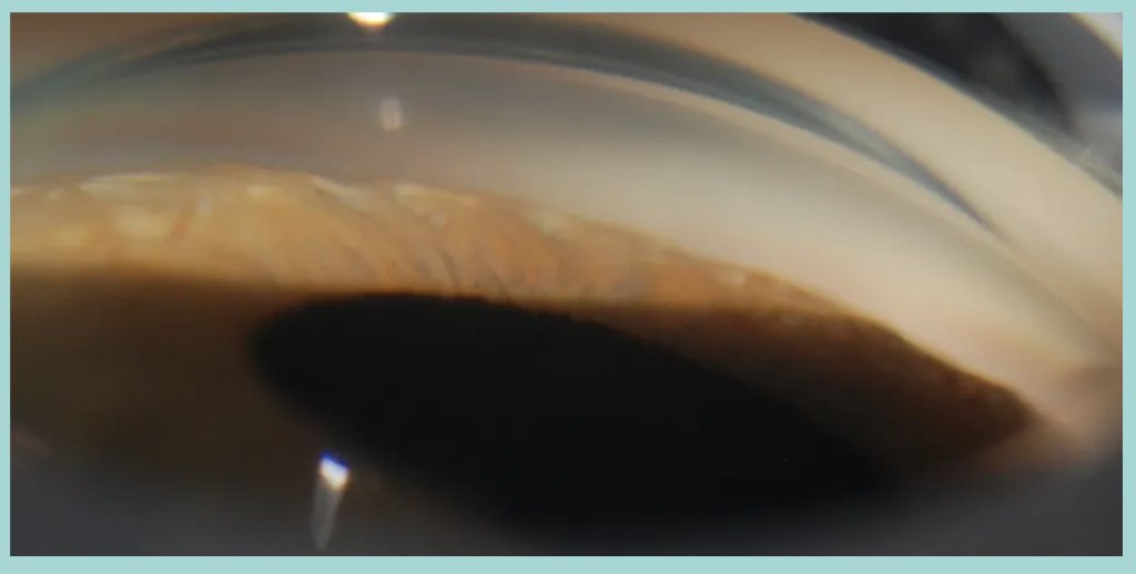 20_20SIM's tweet photo. What's #gonioscopy? What's shown in the #eye image below?

👉case8⃣: https://t.co/KU0i7bgMD1🤓

#VirtualEd #Ophthotwitter #MedEd https://t.co/5Lu1dIBhkU