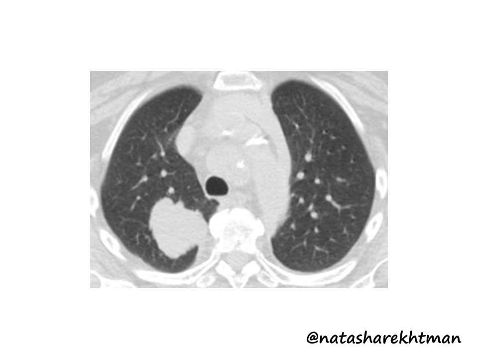 Natasha Rekhtman MD PhD tweet media