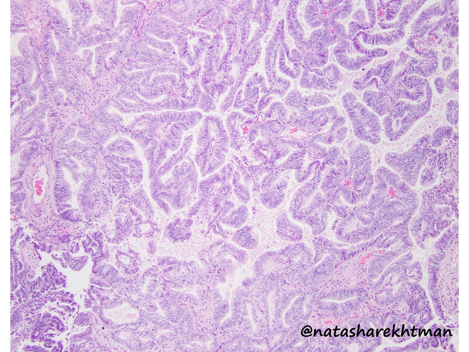 Natasha Rekhtman MD PhD tweet media