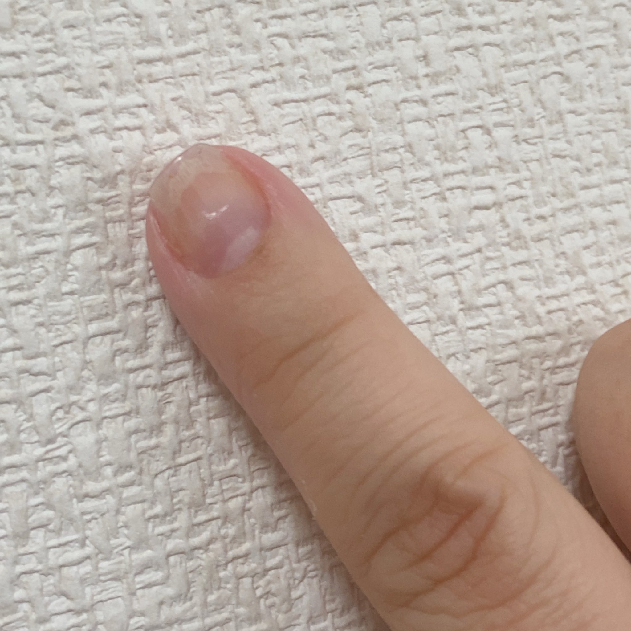 ナオ 生きる 目下の課題は このイエローラインも表面も何もかもガタガタの右手人差し指 剥離しては少し回復し また剥離しては回復 の繰り返し 今は回復期 剥離の少し前にどうにもヒリヒリ痛い時期が来る それが剥離開始のサイン どうしたらええんや