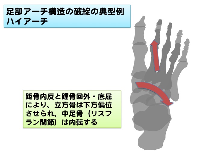 タツ スポーツトレーナー Twitterren 足部アーチ構造の破綻の典型例 距骨内反と踵骨回外 底屈により立方骨の下方偏位が誘導され 外側 縦アーチが降下した状態になる 生じやすいマルアライメントは踵骨回外 底屈 立方骨降下 舟状骨に対する内側楔状骨底屈 Https