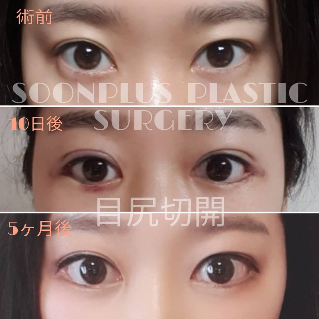 SoonplusJ's tweet photo. ❤スーンプラス整形外科❤
の目尻切開は後戻りのしない、効果が良い目尻切開です。
💥目尻切開に関する誤った俗説💥
1、目尻切開は後戻りする NO!
2、目尻切開は目尻まで下げることができない NO!
3、効果が少ない手術 NO!
4、傷跡がひどく残る NO!
#soonplus #スーンプラス #目整形
#目尻切開 https://t.co/TXj0qi8DrT