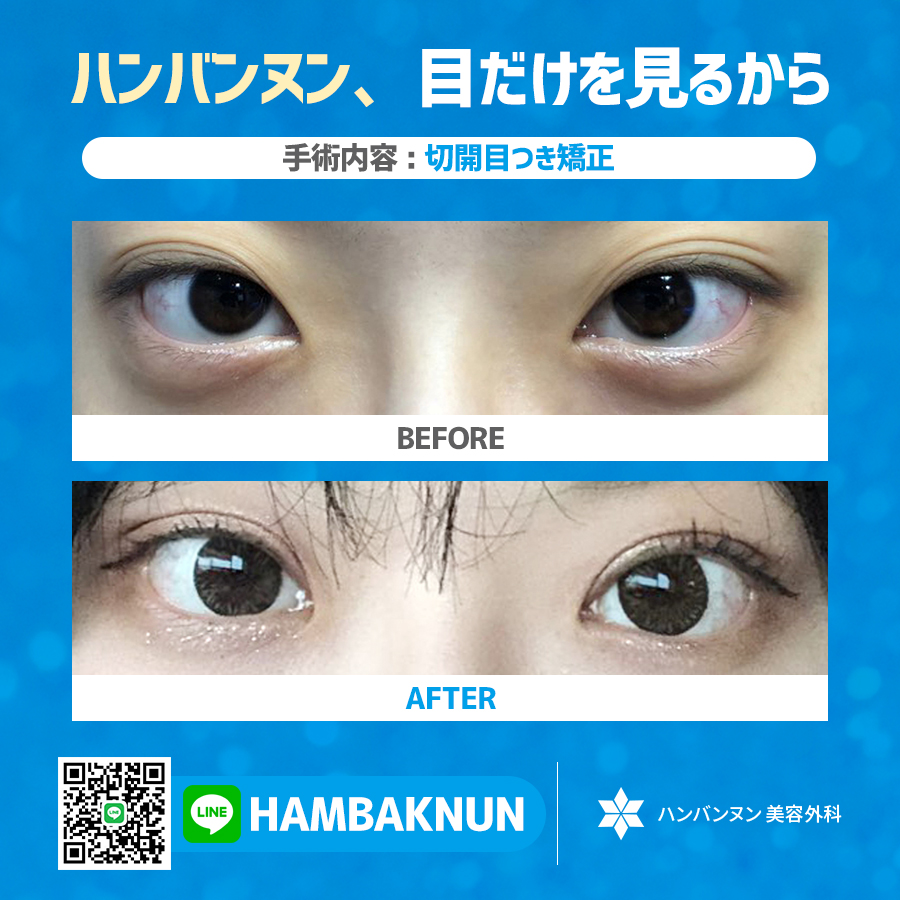 hambacnun's tweet photo. 美しさの基準となるハンバンヌンの目整形ソリューション!
二重切開と目元矯正の完璧なシナジー!
本院で手術を受けられた患者様の手術前後の姿です。
#自然な　#目整形　　#眠そうな目　Good-bye
自然ではっきりとした目元で自信をつける! https://t.co/5Qkcs91Zb9