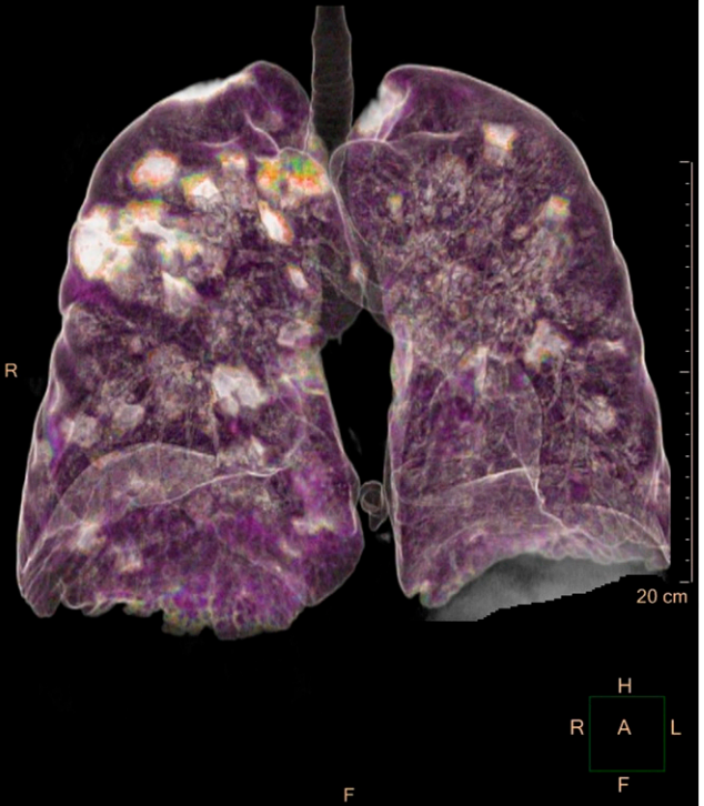 AJTMH's tweet photo. New in our Images section:  "Peribronchial Consolidation w Surrounding Ground-Glass Opacity in #COVID-19 Pneumonia: 3D Reconstruction of Chest Computed Tomography" &amp;"The Lungs before &amp; after COVID-19 #Pneumonia" https://t.co/p8XRf0pOTr https://t.co/cIZvb7oI2L @orsimarcello @ASTMH https://t.co/IzM3DYYgUu