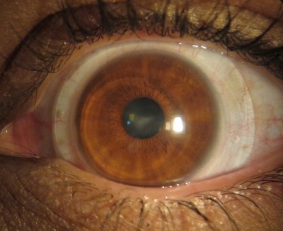 EuropaScleral's tweet photo. Do I need an #sMap3D to successfully fit the Europa? Absolutely not! Whether you own an sMap3D or not, you and your patients benefit from our vast store of scleral knowledge. https://t.co/VMJwJXPIvL