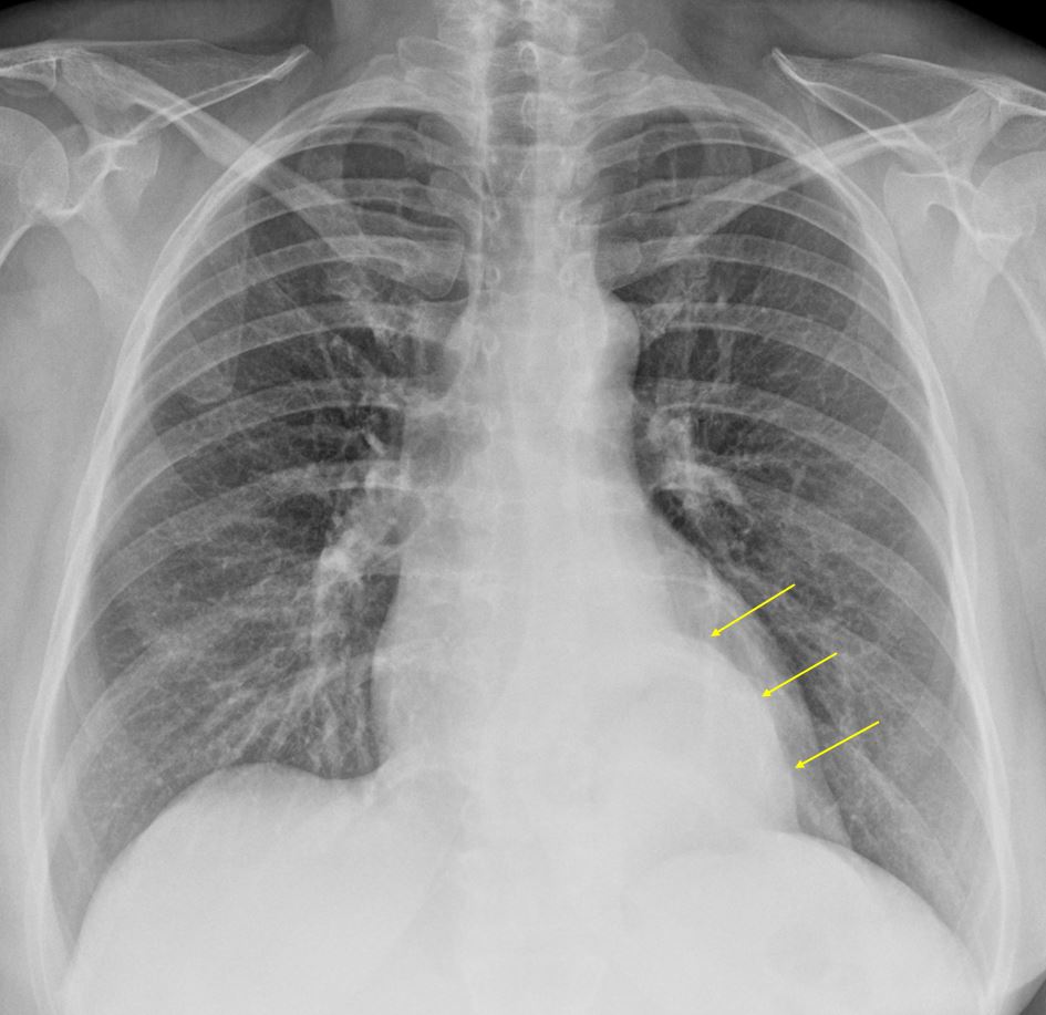 Paraesophageal Hernia X Ray