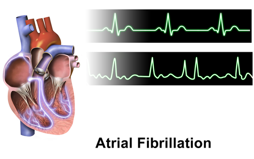 DavidDewhurst18's tweet photo. Do you have Atrial Fibrilation? Do you want to help make treatments as effective as possible for people in the Northwest of England? If so, please follow this link: https://t.co/3f604LAqIc and complete our online screener. #HaveYourSay @talktodebbie @michrushtonCHC https://t.co/i6QVQ19anF