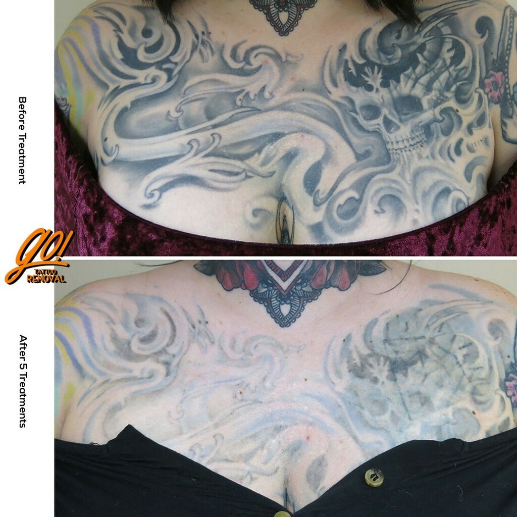 Laser Tattoo Removal  Contour Dermatology