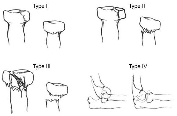 Orthopaedics MSc UCL (@orthomscucl) on Twitter photo Mason Classification - radial head fractures:
Type 1 - Nondisplaced or minimally displaced (<2mm), no mechanical block to rotation
Type 2 - Displaced >2mm or angulated, possible mechanical block to forearm rotation 
..... (1/2) 
#orthotwitter #MScUCL Mason Classification - radial head fractures:
Type 1 - Nondisplaced or minimally displaced (<2mm), no mechanical block to rotation
Type 2 - Displaced >2mm or angulated, possible mechanical block to forearm rotation 
..... (1/2) 
#orthotwitter #MScUCL