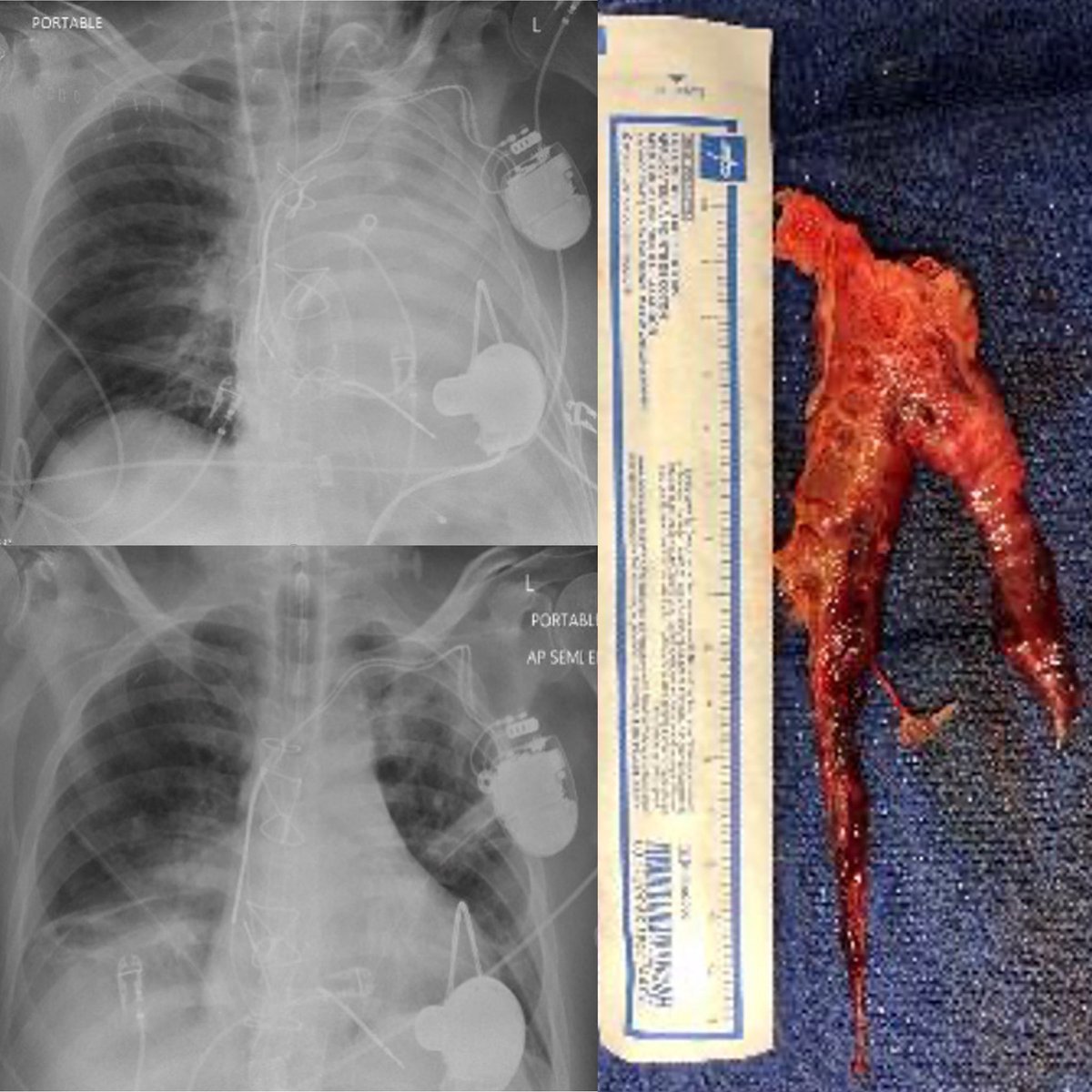 Reward for perseverance. 
Massive alveolar hemorrhage in a patient on VA-ECMO, creating full clot and fibrin cast of lower trachea and main bronchi.
Eventually extracted with therapeutic cryoprobe after MULTIPLE bronchoscopies.   With <a href="/pulmo_dok/">Napoleon Puente</a>