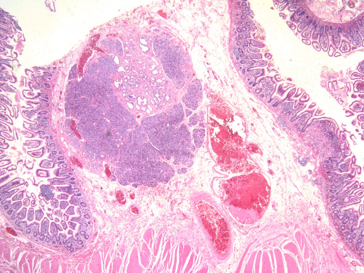 jake_bledsoe's tweet image. Meckel's diverticulum with pancreatic and gastric heterotopia. #GIpath #pathology