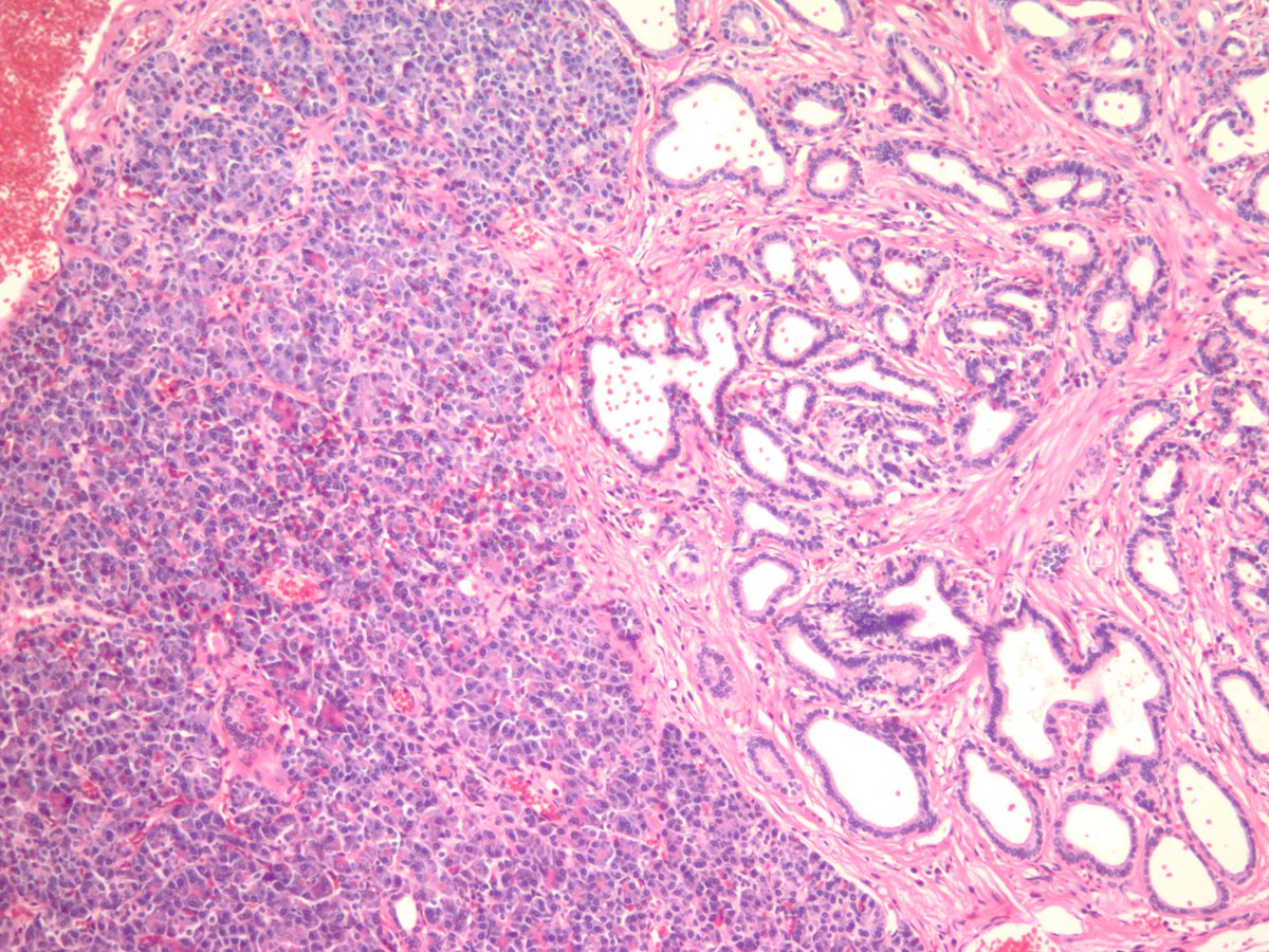 jake_bledsoe's tweet image. Meckel's diverticulum with pancreatic and gastric heterotopia. #GIpath #pathology