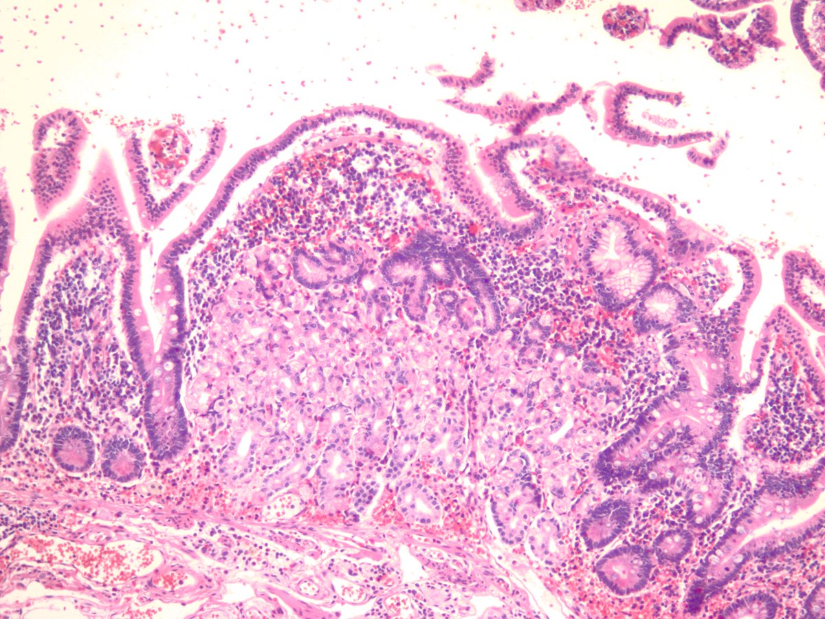jake_bledsoe's tweet image. Meckel's diverticulum with pancreatic and gastric heterotopia. #GIpath #pathology