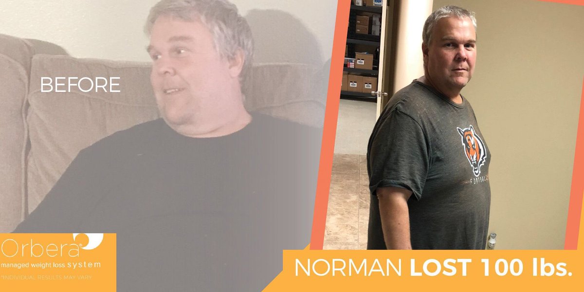 Norman lost 100 lbs with Orbera
#Orbera #Weightloss #weightlossjourney #weightlossprogram #weightlosstransformation #losinginches #fitnessmotivation #weightlosssuccess #orberaballoon #gastricballoon #wls #wlscommunity #wlsbeforeandafter #beforeandafter #wlstransformation