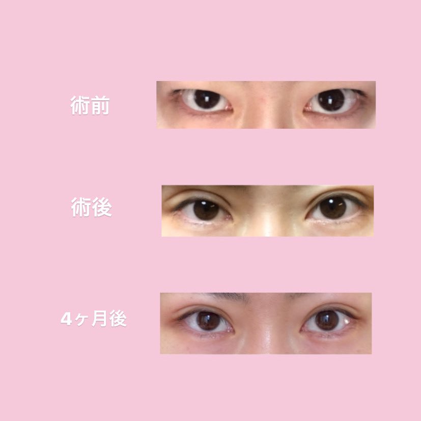 二重整形失敗確率