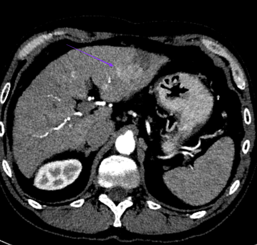 urmed_ir's tweet photo. 60 year old with HCC successfully treated with #Y90. Cancer doesn't care about COVID-19, so the show must go on. #Irad #MIIP #BasicIR #TwittIR #InnovationToHeal #Interventional #Radiology #Angio https://t.co/6Q1fVcl8RE