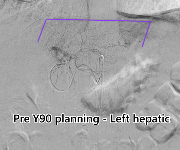 urmed_ir's tweet photo. 60 year old with HCC successfully treated with #Y90. Cancer doesn't care about COVID-19, so the show must go on. #Irad #MIIP #BasicIR #TwittIR #InnovationToHeal #Interventional #Radiology #Angio https://t.co/6Q1fVcl8RE
